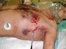 Trauma.org | Image | Shotgun wound to the chest with haemothorax