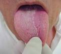 <b>Doenças</b> na <b>Língua</b>