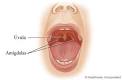 como <b>absceso peritonsilar</b>.