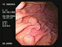 Gastric Polyps II, El Salvador Atlas of Gastrointestinal Video ...