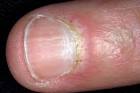 Dermatomyositis Picture : Fingernail (Hardin MD Super Site Sample)