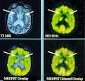 Huntington's Disease