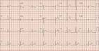 <b>premature atrial</b>