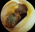 Giant Ear Wax Gunk - Use a Q Tip Please | Pop That Zit