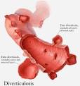 Granville Health System | Diverticular Disease