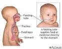 Feeding tube