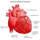 Anomalous Coronary Artery (ACA) | CHOP | The Children's Hospital ...