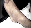 Idiopathic thrombocytopenic purpura - Wikipedia, the free encyclopedia