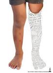 “When you lose a <b>leg</b> you don't