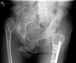 <b>Fibrous Dysplasia</b> - PORTNotes