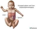 Gaucher Disease :: Nationwide Children's Hospital