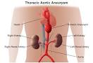 Thoracic <b>Aortic Aneurysm</b> | Patient Care & Services | Vascular and