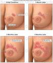 Inflammatory breast cancer prognosis | Healthy Lifestyle
