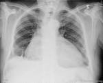 Rx Tórax: <b>Cardiomegalia</b>