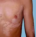 Vitiligo Overview