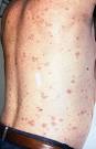 Typhus
