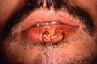 Cold Sores Pictures 4 : AIDS / HIV (Hardin MD / CDC)