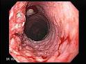 Esophagus Cancer, El Salvador Atlas of Gastrointestinal Video ...