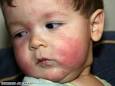 a strong allergic reaction