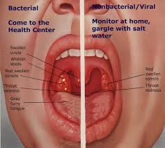   Tonsillitis 