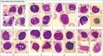 mononucléosique : <b>cellules</b>
