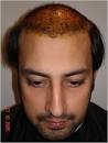 Hair Club - Baber Ali