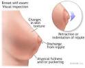 Breast Cancer Symptoms - Breast Cancer Health Information - NY ... 
