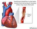 Nanda Nursing Diagnoses: 4 - Nursing Diagnoses Angina Pectoris