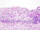 File:Cervical intraepithelial neoplasia (2) koilocytosis.jpg ...