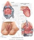 <b>Sexually Transmitted Diseases</b> - Netter Medical Artwork
