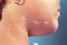 <b>Localized Scleroderma</b>: Morphea