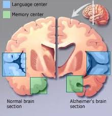مرض الزهايمر - الخرف المبكر Alzheimer’s disease ا Images?q=tbn:ANd9GcSCrkc09D5WwtbRlgSHQWzoBT9qUC7n8lUF2UZFdpFntqxUzOfdrA