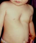 <b>Funnel chest</b> (hollowed <b>chest</b>)
