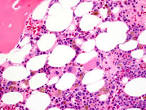<b>Myelodysplastic Syndrome</b>