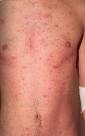 HIV Rash | STD & Sexual Health Information