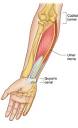Neuropathy Of <b>Ulnar Nerve</b>