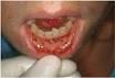 Severe <b>mucositis</b>