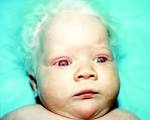 oculocutaneous albinism 1A
