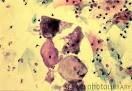 Bacteroides Infection | Humen Healths
