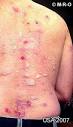 Morgellons disease picture - Morgellons diagnosis of rare mycosis