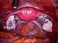 A <b>laparoscopy</b> being performed.