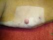 Mastocytoma - Wikipedia, the free encyclopedia