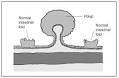 What I need to know about Colon Polyps - National Digestive ...