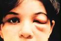 Acute <b>Chagas Disease</b> in a