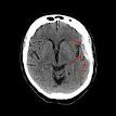 <b>Subdural hematoma</b> - Wikipedia