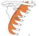 <b>Atteintes Rétrocochléaires</b>; maladies retrocochleaires