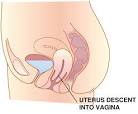 What is Vaginal Prolapse?