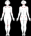 American College of Rheumatology (ACR) 1990 Diagnostic Criteria ...