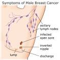 All about Male Breast Cancer