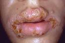 15 Cities With the Worst Herpes Rates in the U.S. | What in the ...